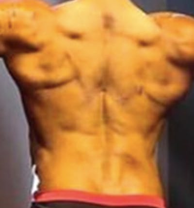 Bro Line Back Lift ™ Before & After Gallery - Patient 553814 - Image 2