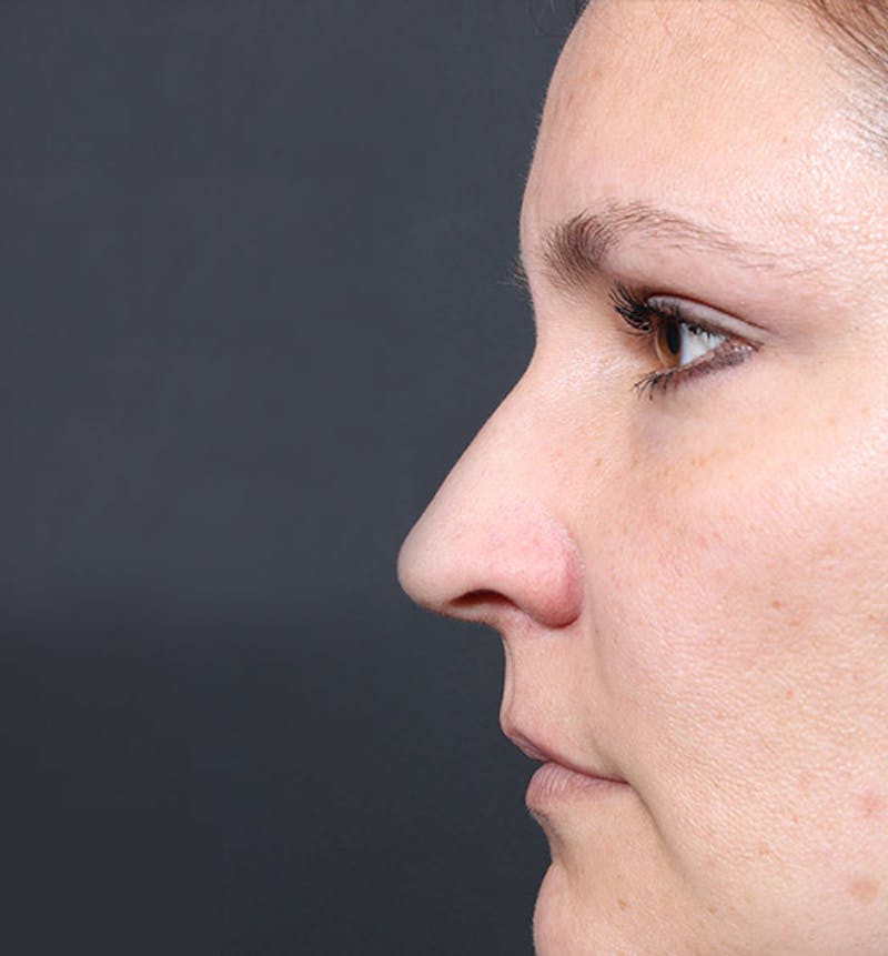 Non-Surgical Rhinoplasty Before & After Gallery - Patient 341391 - Image 5