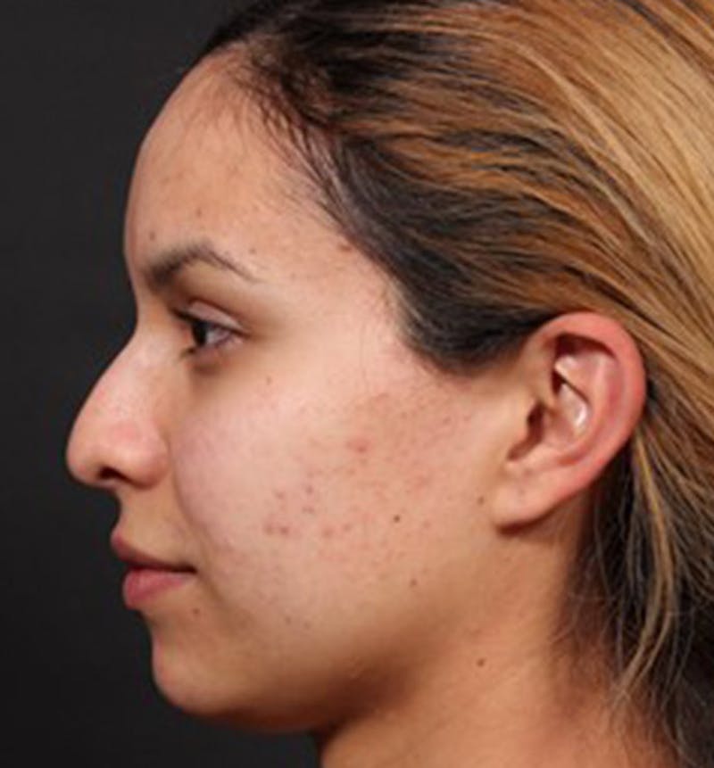 Non-Surgical Rhinoplasty Before & After Gallery - Patient 199100 - Image 1