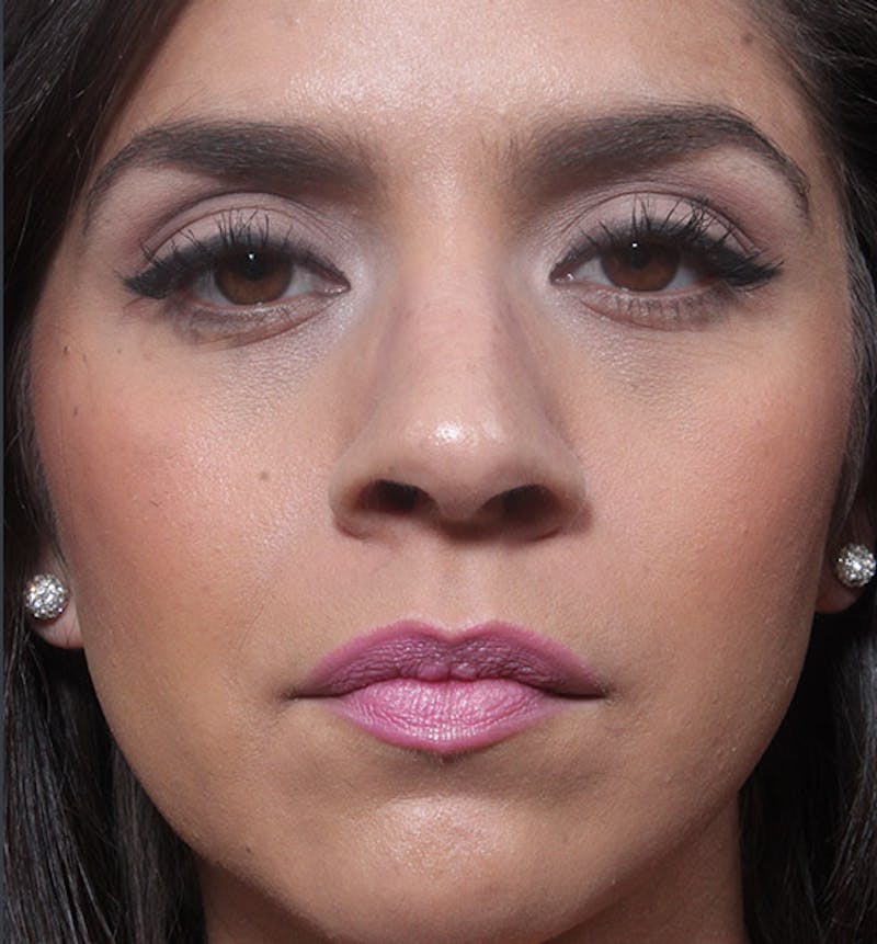 Rhinoplasty Before & After Gallery - Patient 263545 - Image 3