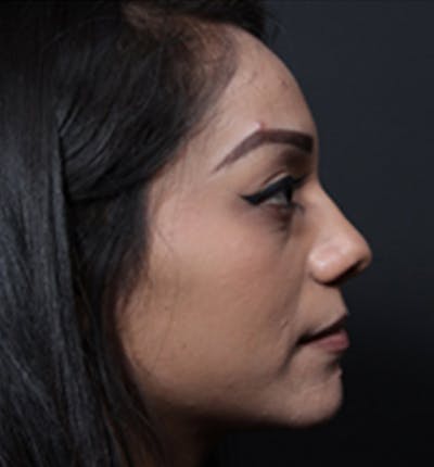 Non-Surgical Rhinoplasty Before & After Gallery - Patient 327036 - Image 1