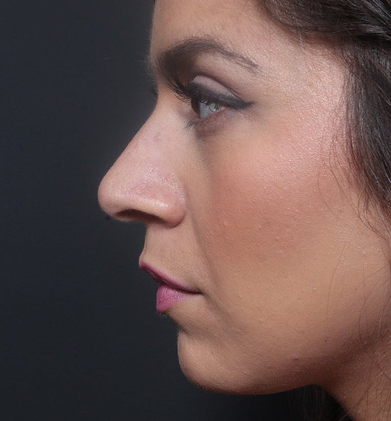 Rhinoplasty Before & After Gallery - Patient 263545 - Image 5