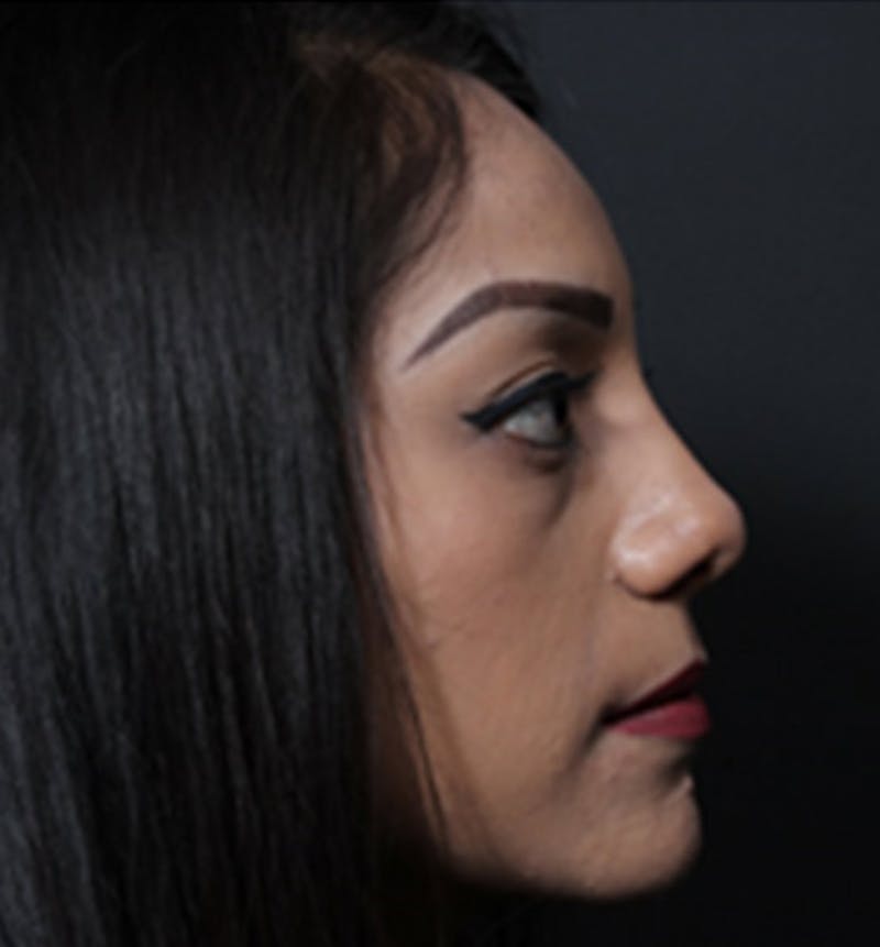 Non-Surgical Rhinoplasty Before & After Gallery - Patient 327036 - Image 2