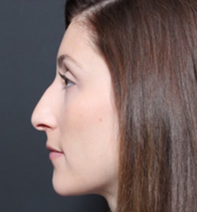Non-Surgical Rhinoplasty Before & After Gallery - Patient 368558 - Image 1