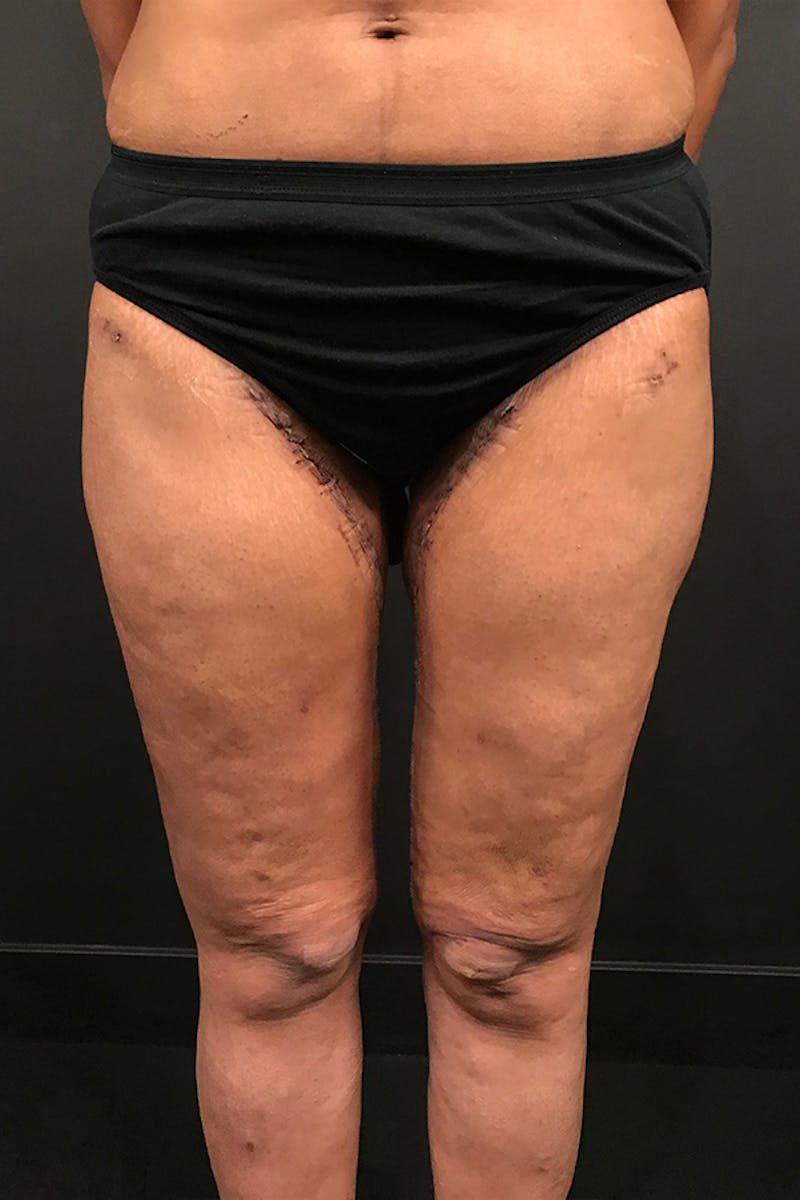 Thigh Lift Before & After Gallery - Patient 913913 - Image 4
