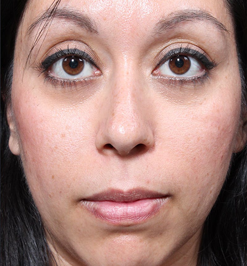 Rhinoplasty Before & After Gallery - Patient 169573 - Image 3