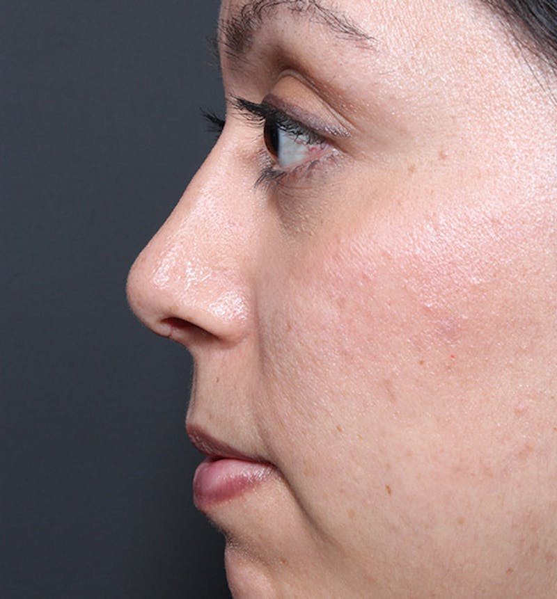 Rhinoplasty Before & After Gallery - Patient 169573 - Image 6