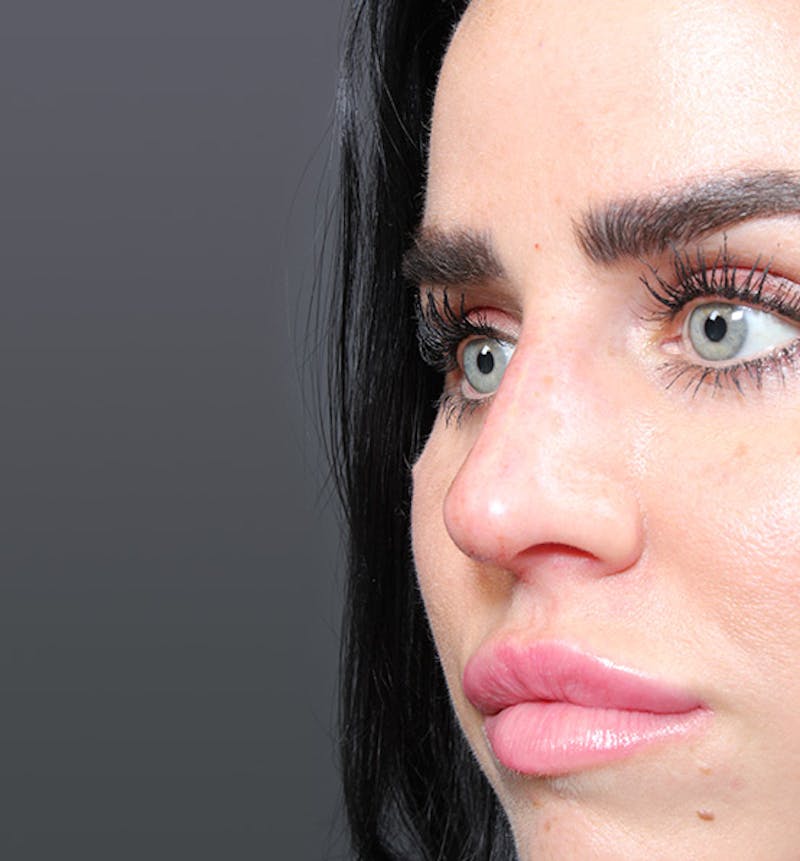 Non-Surgical Rhinoplasty Before & After Gallery - Patient 382392 - Image 6