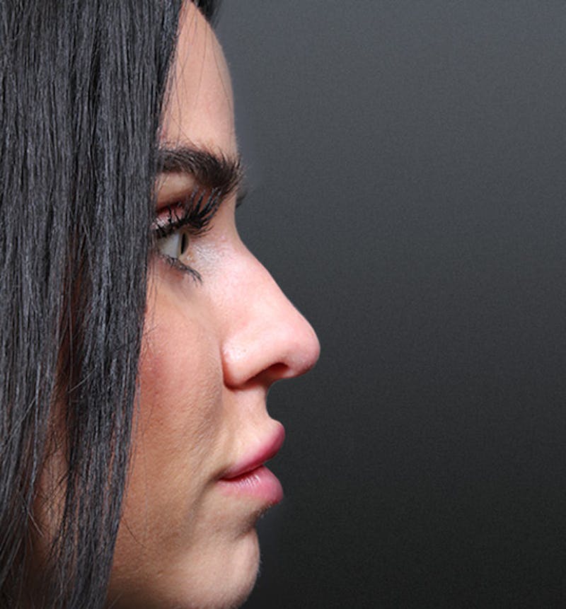 Non-Surgical Rhinoplasty Before & After Gallery - Patient 382392 - Image 7