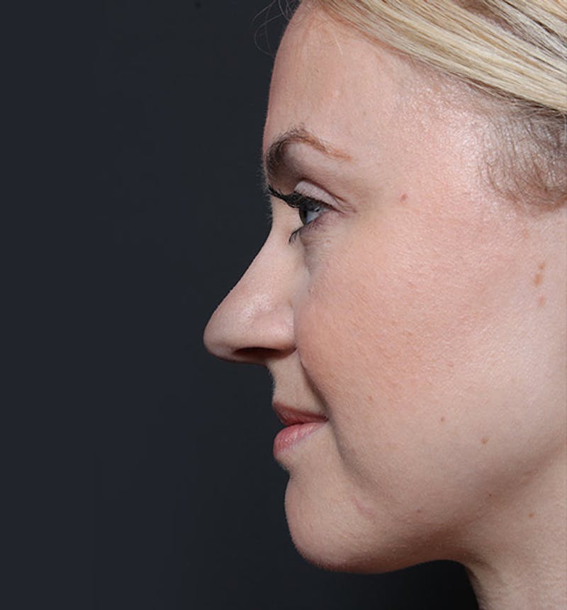 Rhinoplasty Before & After Gallery - Patient 887082 - Image 5