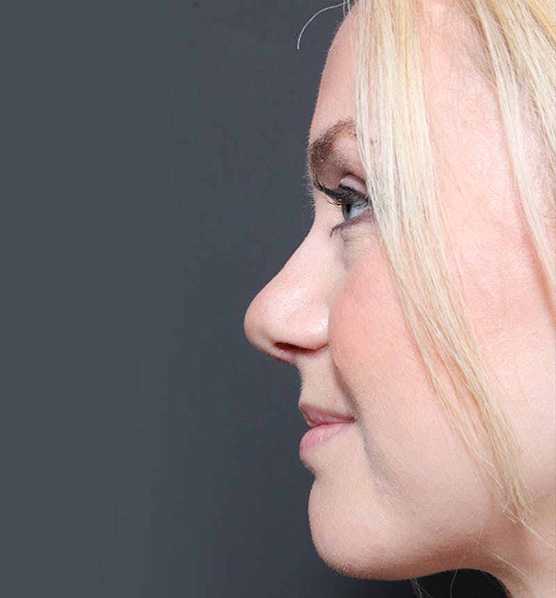 Rhinoplasty Before & After Gallery - Patient 887082 - Image 6