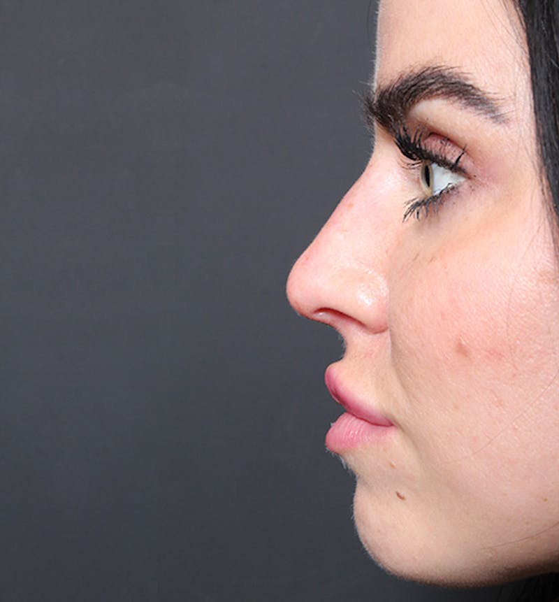 Non-Surgical Rhinoplasty Before & After Gallery - Patient 382392 - Image 10