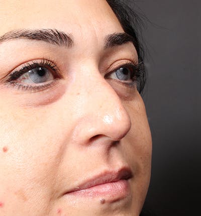 Non-Surgical Rhinoplasty Before & After Gallery - Patient 221579 - Image 1