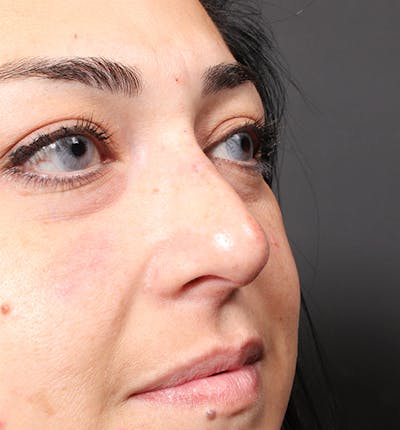 Non-Surgical Rhinoplasty Before & After Gallery - Patient 221579 - Image 2