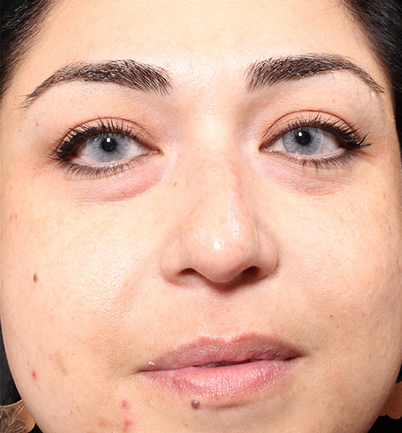 Non-Surgical Rhinoplasty Before & After Gallery - Patient 221579 - Image 3