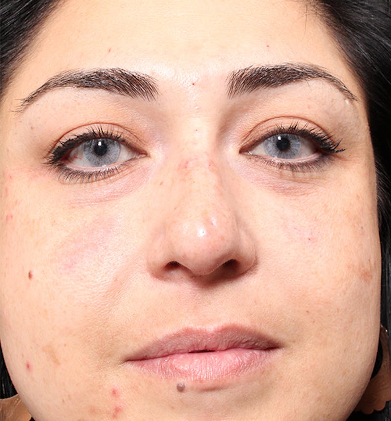 Non-Surgical Rhinoplasty Before & After Gallery - Patient 221579 - Image 4