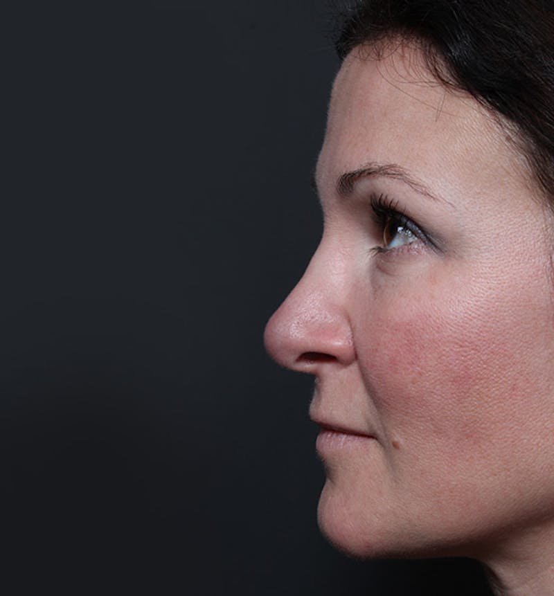 Rhinoplasty Before & After Gallery - Patient 112876 - Image 5