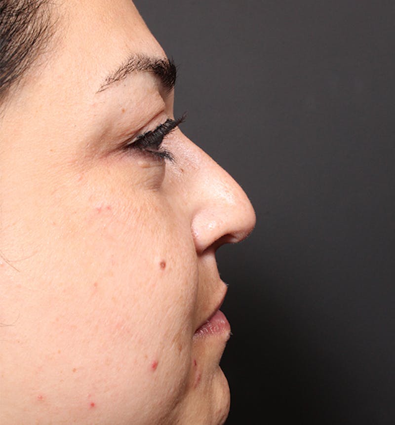 Non-Surgical Rhinoplasty Before & After Gallery - Patient 221579 - Image 5