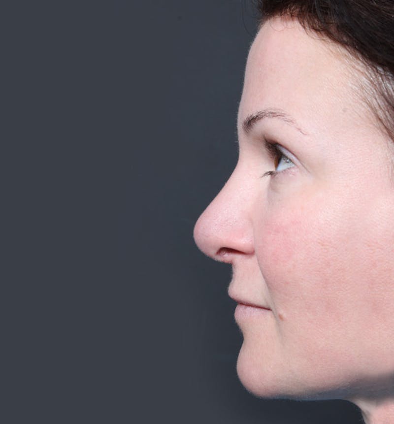 Rhinoplasty Before & After Gallery - Patient 112876 - Image 6