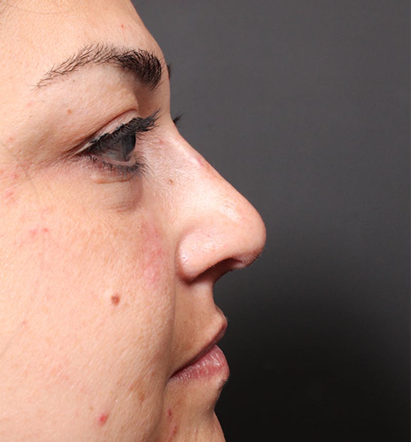 Non-Surgical Rhinoplasty Before & After Gallery - Patient 221579 - Image 6