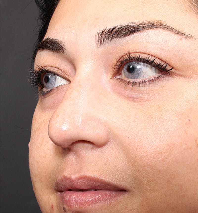 Non-Surgical Rhinoplasty Before & After Gallery - Patient 221579 - Image 7