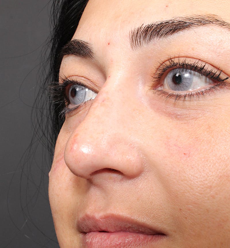 Non-Surgical Rhinoplasty Before & After Gallery - Patient 221579 - Image 8
