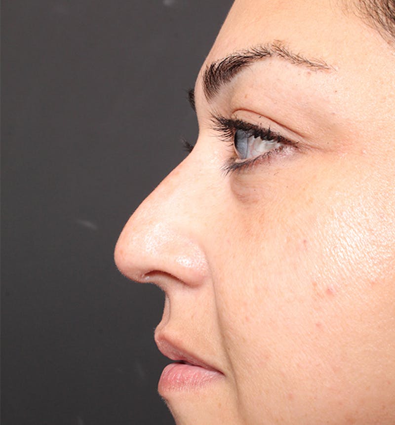 Non-Surgical Rhinoplasty Before & After Gallery - Patient 221579 - Image 9