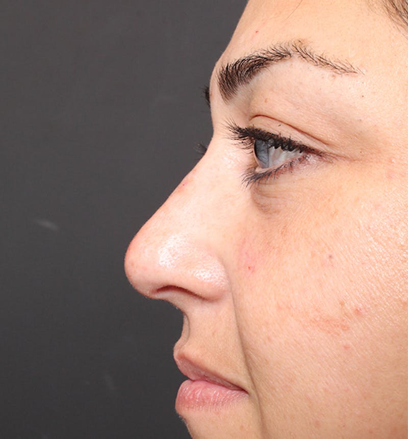 Non-Surgical Rhinoplasty Before & After Gallery - Patient 221579 - Image 10