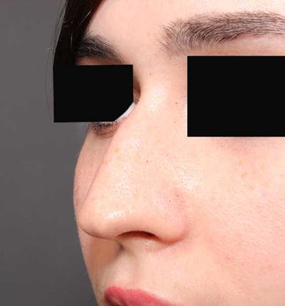 Non-Surgical Rhinoplasty Before & After Gallery - Patient 549415 - Image 1