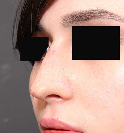 Non-Surgical Rhinoplasty Before & After Gallery - Patient 549415 - Image 2