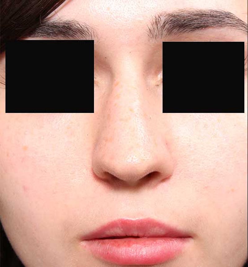 Non-Surgical Rhinoplasty Before & After Gallery - Patient 549415 - Image 3