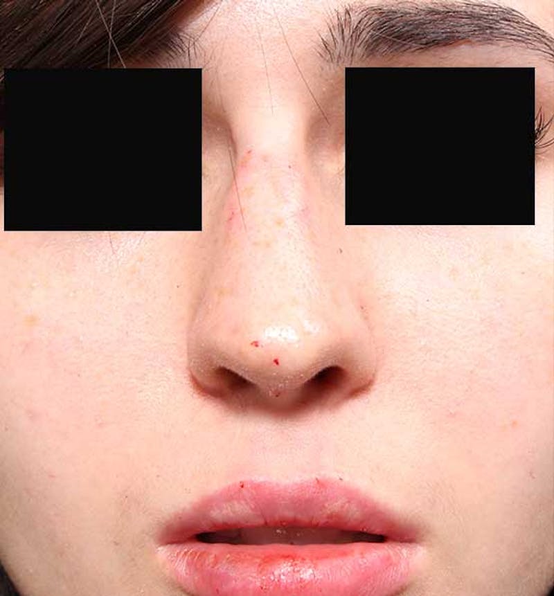 Non-Surgical Rhinoplasty Before & After Gallery - Patient 549415 - Image 4