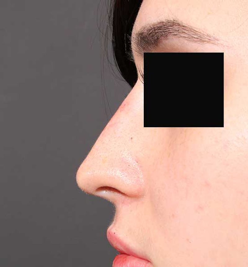 Non-Surgical Rhinoplasty Before & After Gallery - Patient 549415 - Image 6