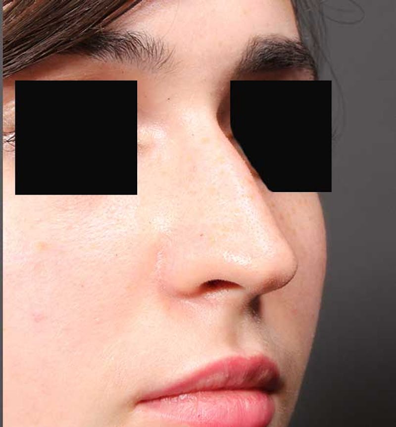 Non-Surgical Rhinoplasty Before & After Gallery - Patient 549415 - Image 7