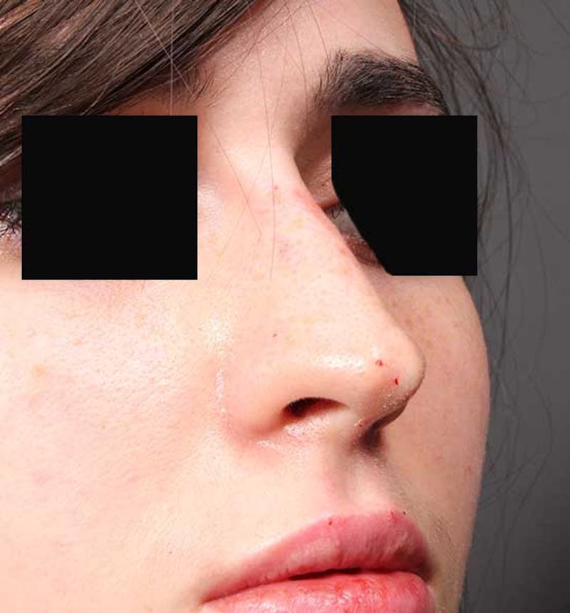 Non-Surgical Rhinoplasty Before & After Gallery - Patient 549415 - Image 8