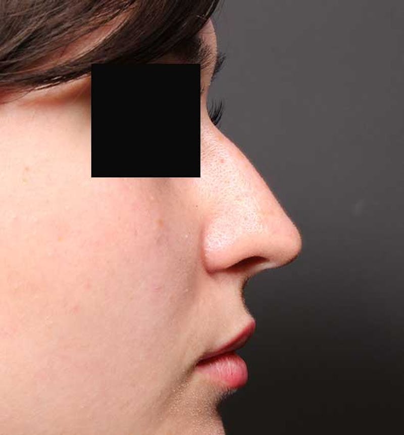 Non-Surgical Rhinoplasty Before & After Gallery - Patient 549415 - Image 9