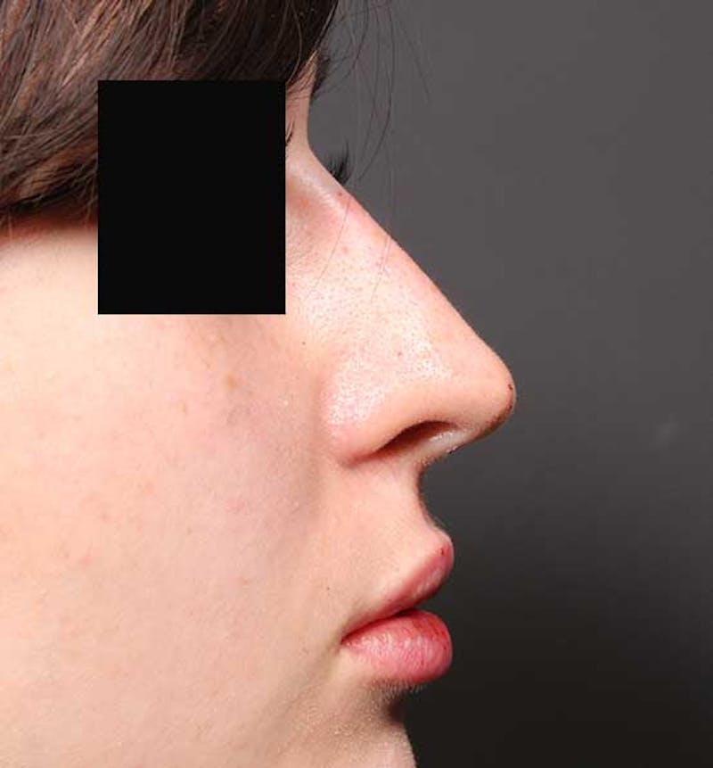 Non-Surgical Rhinoplasty Before & After Gallery - Patient 549415 - Image 10