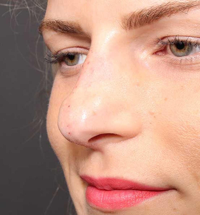 Non-Surgical Rhinoplasty Before & After Gallery - Patient 847484 - Image 4