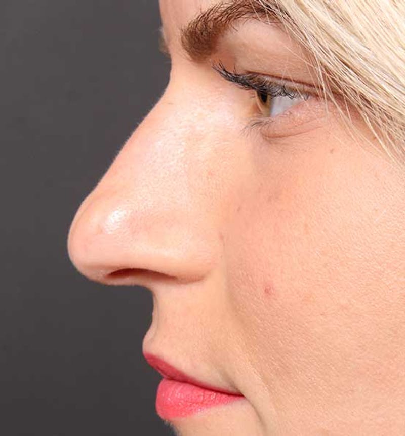 Non-Surgical Rhinoplasty Before & After Gallery - Patient 847484 - Image 5