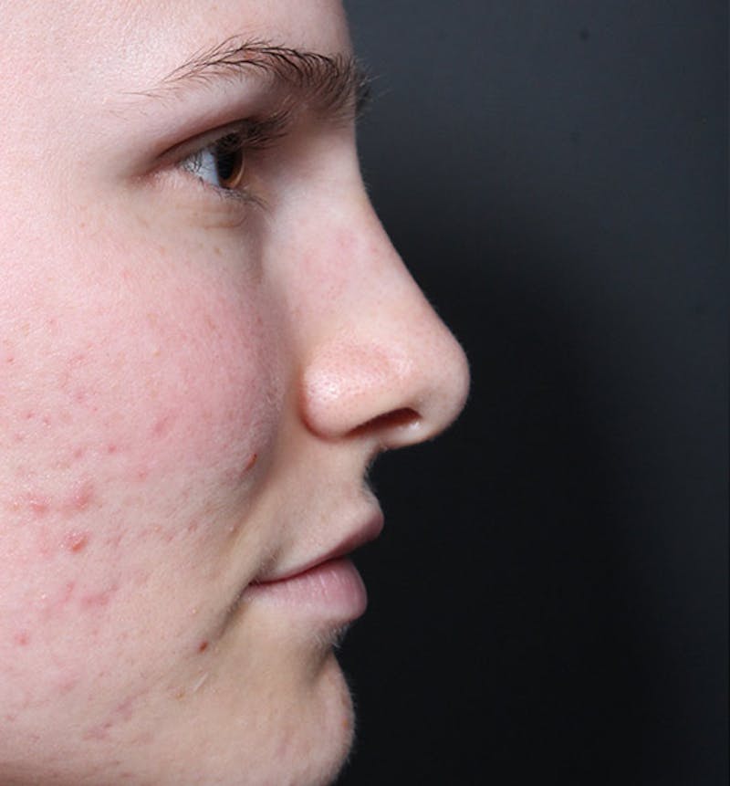 Rhinoplasty Before & After Gallery - Patient 364743 - Image 10