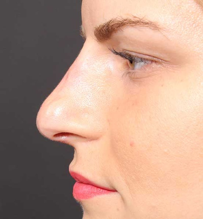 Non-Surgical Rhinoplasty Before & After Gallery - Patient 847484 - Image 6