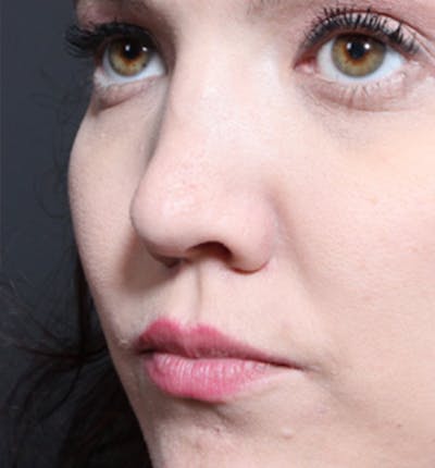 Rhinoplasty Before & After Gallery - Patient 377801 - Image 1