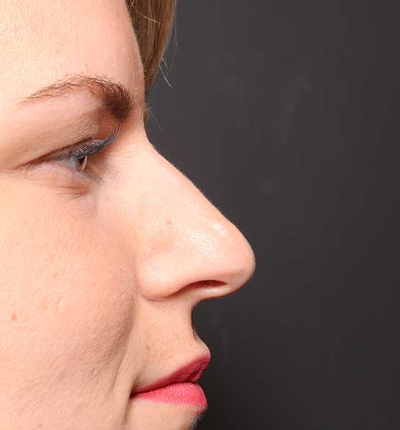 Non-Surgical Rhinoplasty Before & After Gallery - Patient 847484 - Image 9