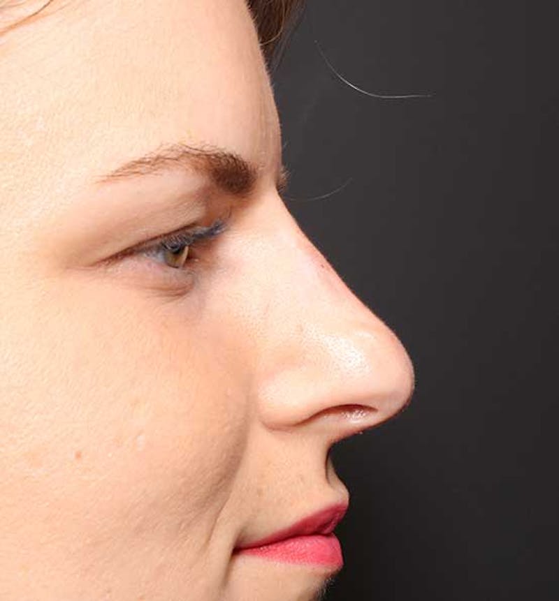 Non-Surgical Rhinoplasty Before & After Gallery - Patient 847484 - Image 10
