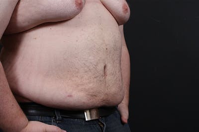 Liposuction Before & After Gallery - Patient 141841 - Image 2
