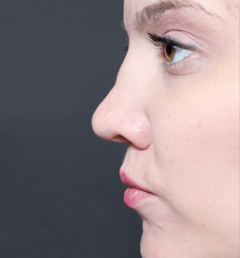 Rhinoplasty Before & After Gallery - Patient 377801 - Image 5