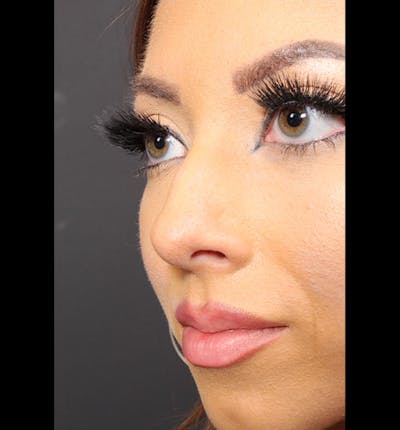 Non-Surgical Rhinoplasty Before & After Gallery - Patient 131196 - Image 1