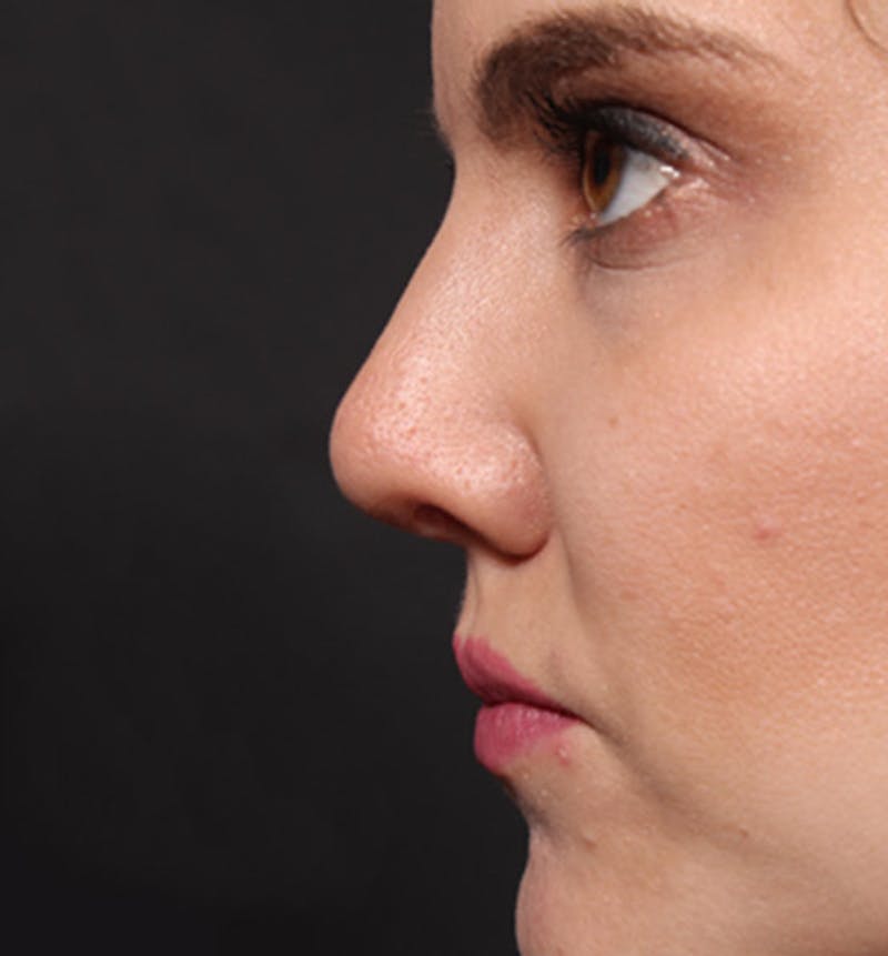 Rhinoplasty Before & After Gallery - Patient 377801 - Image 6