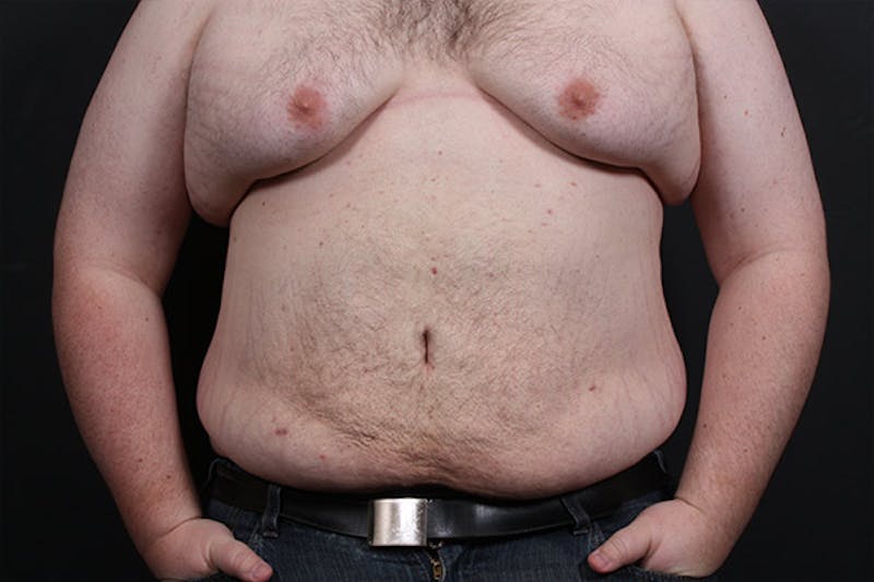 Liposuction Before & After Gallery - Patient 141841 - Image 4