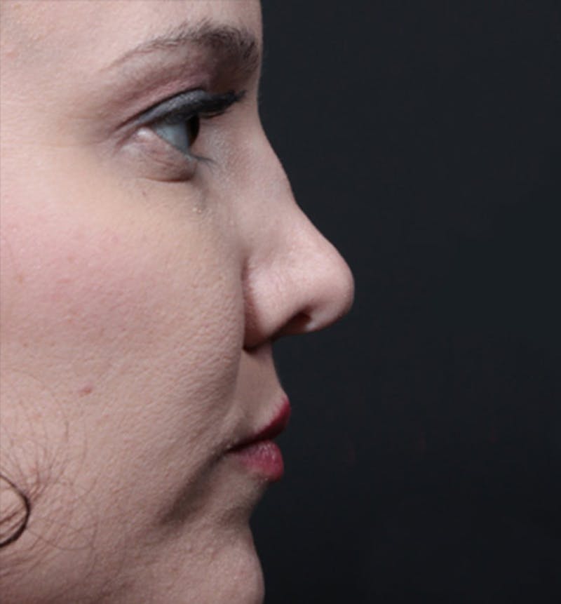 Rhinoplasty Before & After Gallery - Patient 377801 - Image 7